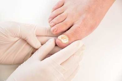 Fungal Nail Care is Critical