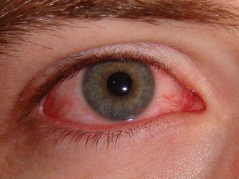 How long does pink eye last? 7 signs you are still contagious