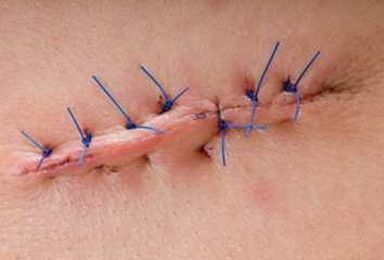 The Difference Between Healing and Infected Surgical Wounds