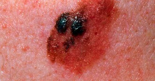 An Expert Dermatologist Weighs In On The Controversial "Base Tan" Theory