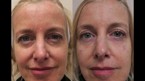 Treatment of Under Eye Dark Circles and Bags with Restylane Filler