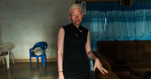 The Albino Community in Ghana: ‘I’m Motivated to Believe That I Can Survive’ 