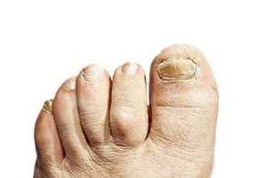 The Benefits Of Laser Treatment For Toenail Fungus