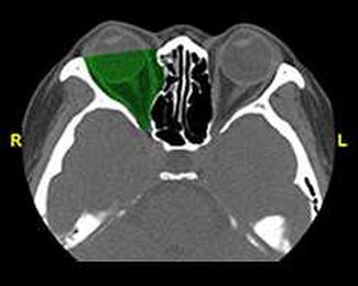 Patients with blowout fractures can improve with minimal treatment