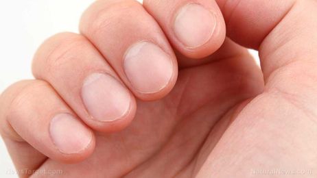 7 Things that can happen if you keep biting your nails