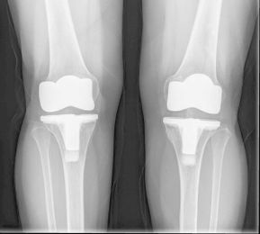 New Patient-Outcomes Data Hint at Benefits from Computer-Navigated TKA