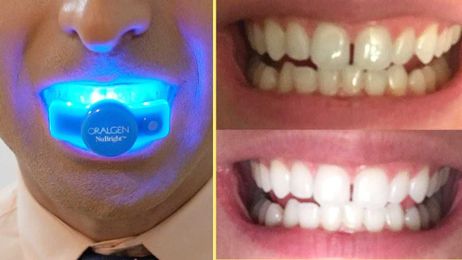 How to INSTANTLY WHITEN YOUR TEETH at Home (BEST IN HOME WHITENING KIT)