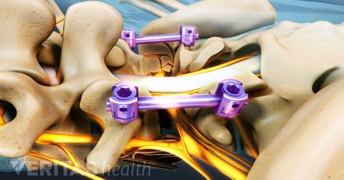 Reader Roundup:  8 Things Our Readers Wish They Considered Before Spine Surgery