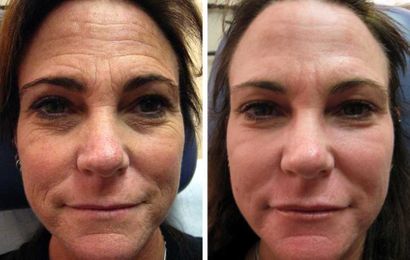 What is CO2 Laser Resurfacing?