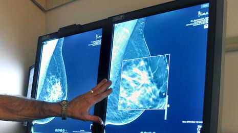 Should you get a 3D mammogram? What you should know about how the screening detects breast cancer