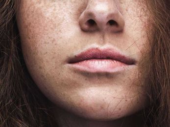 Freckles: Causes, identification, and risks