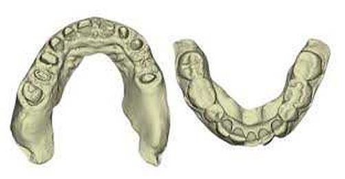 How Accurate are 3D Printed Dental Models?