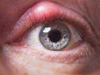 Stye: Causes, prevention, and treatment
