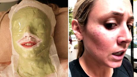 Ice Facials: What to know before you go