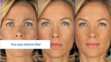Why Botox Continuously Increasing in Demand?