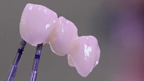 Gain a winning smile with glass-ceramics