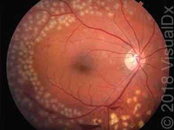 Make the Diagnosis: Eye See the Problem Started Years Ago