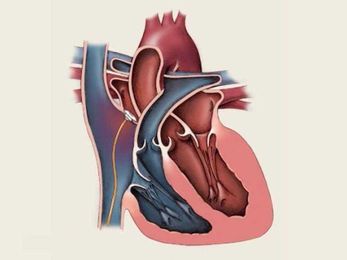 Mayo Clinic Minute: What you need to know about patent foramen ovale
