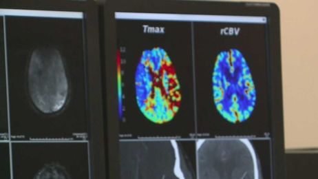 Why American Heart Association says where you get stroke care matters