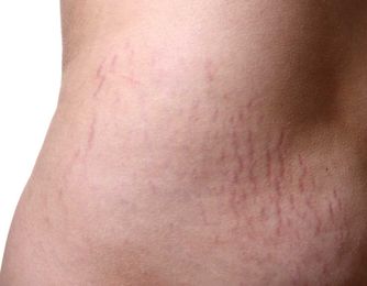 Will I Still Have Stretch Marks After Weight Loss?