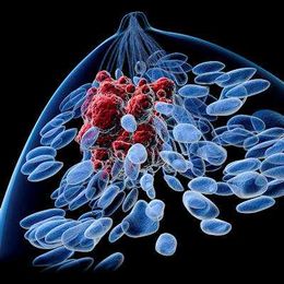 DBT finds cancers associated with better outcomes