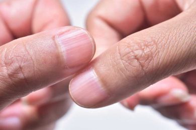 Here's What It Means If You Have Ridges on Your Nails