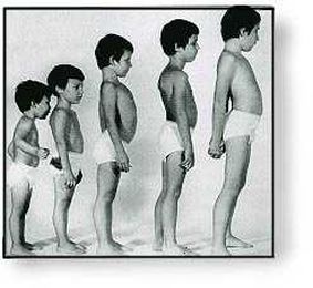 Solid Biosciences: Outlook Post-DMD Data