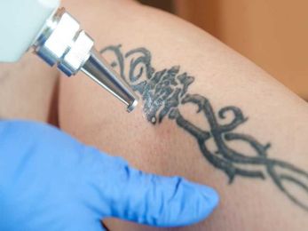 Bad Reaction From a New Tattoo? Here's What to Do