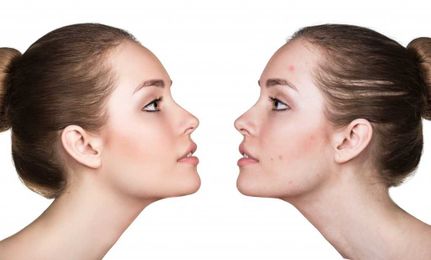 Differences Between Professional Skin Care Products and OTC Products