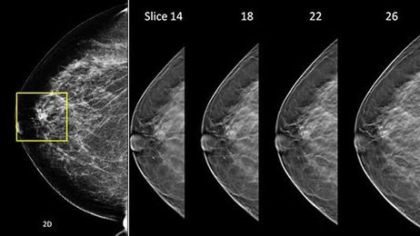 Digital Breast Tomosynthesis Reduces Benign Biopsy Rate