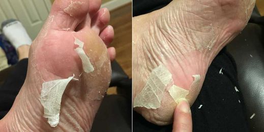 'Baby Foot' Makes Your Feet Peel Like a Snake