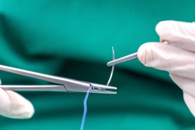 Why it's important to remove the sutures you place