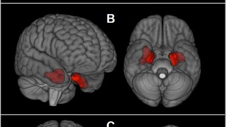 Brain scans may reveal concussion damage in living athletes