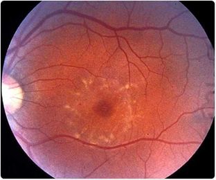 What is Fundus Flavimaculatus?