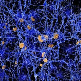 Would high amyloid level spur physician-assisted death?