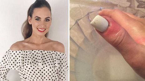 Skin Cancer Can Hide as a Line on Your Nail