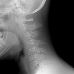 Cages in ACDF are associated with a higher non-union rate than allograft