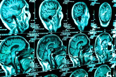 Top Brain Injury Rehabilitation Centers in Chicago