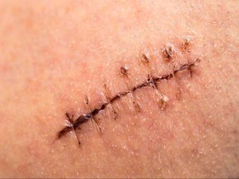 Dissolvable stitches: How long they last, care tips, and removal