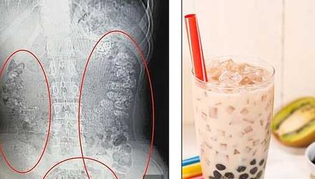 Girl Who Loves Bubble Tea Gets 100 Tapioca Pearls Stuck in Intestines