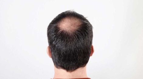 Scientists Have Found a Way to Use Stem Cells to Grow New Hair