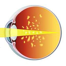 Eye Floaters in the Vitreous: A Guide by Natural Eye Care