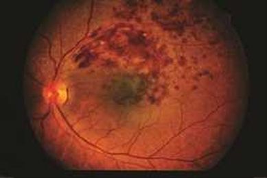 What is a Branch Retinal Vein Occlusion?
