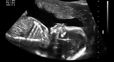 Horrific, little-known abortion method: Cut the umbilical cord and wait for cardiac arrest