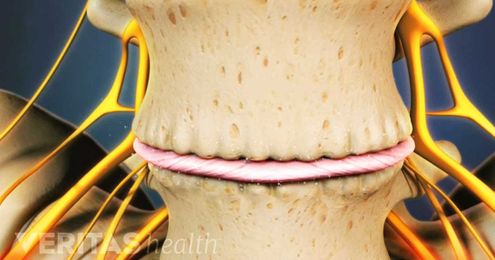 Bone Spurs (Osteophytes) and Back Pain