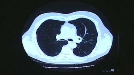 New study explains cancer causes on Buffalo's East Side, Cheektowaga