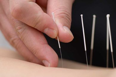 Acupuncture vs. Needling: The Facts and Benefits