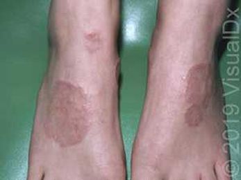 Make the Diagnosis: What are these Itchy, Round Patches?