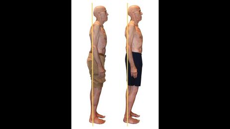 Change Your Posture to heal osteoarthritis