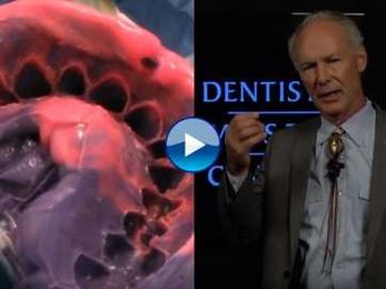 How to Place the Retraction Cord for Veneers